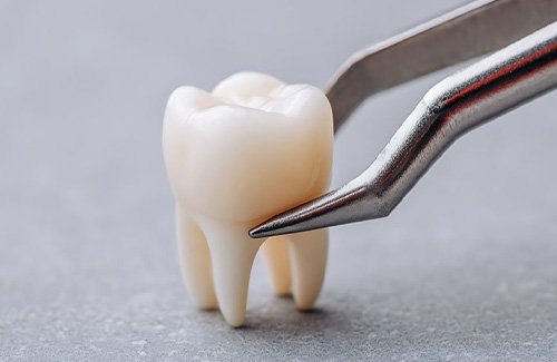Extracted tooth in dental forceps