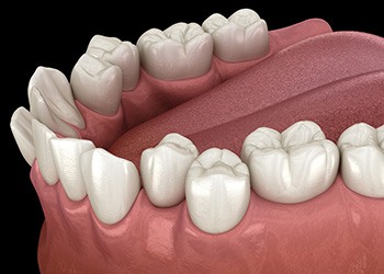 Illustration of crooked teeth
