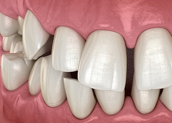 Illustration of gapped teeth