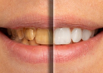 A before and after photo of a cosmetic dentistry patient