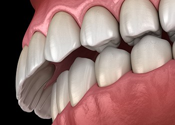 Illustration of an overbite