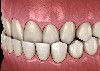 Illustration of an underbite