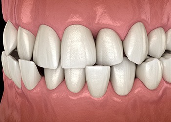 Illustration of a crossbite