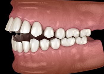 Illustration of an open bite