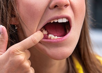 Woman pulling back her lip to reveal a missing tooth