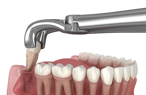 Illustration of a tooth being extracted