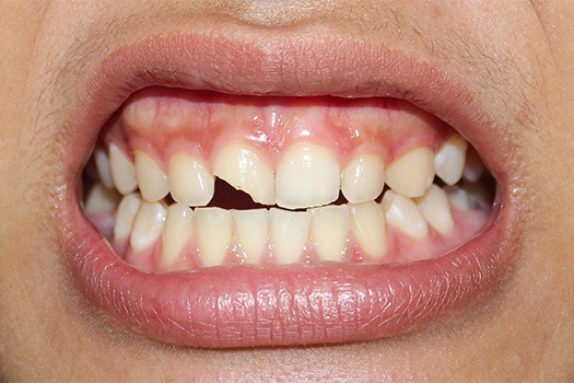 We can repair cavities and broken teeth near Glastonbury Center