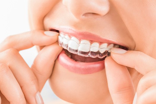 Improve the alignment of your smile with Invisalign near Glastonbury Center