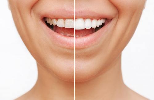 Before and after veneers