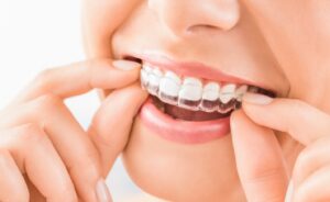 Person fitting Invisalign onto top teeth.